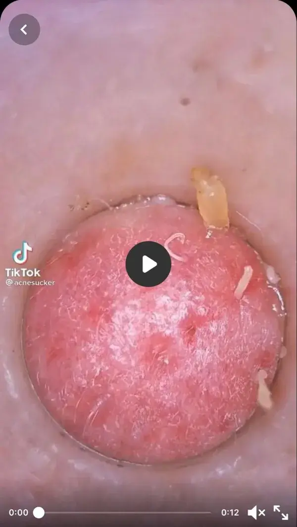 Blackheads extraction