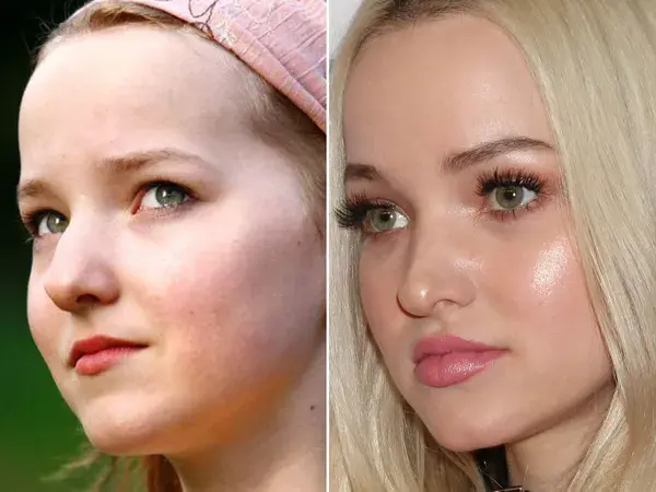 Dove Cameron, Before and After