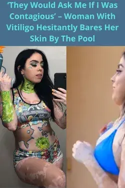 ‘They would ask me if I was contagious’ – woman with vitiligo hesitantly bares her skin by the pool