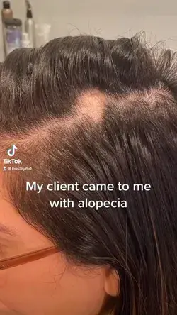 BosleyMD - How to treat alopecia ✨