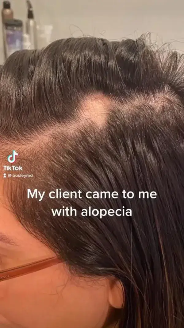 BosleyMD - How to treat alopecia ✨