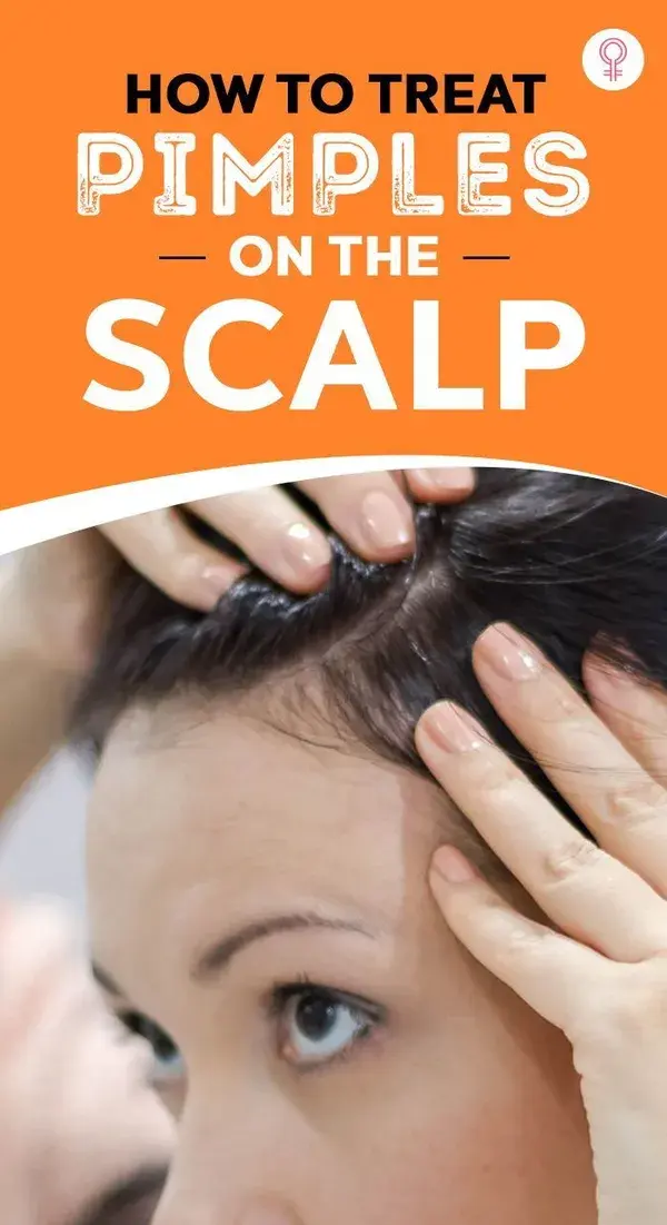 How To Treat Pimples On The Scalp