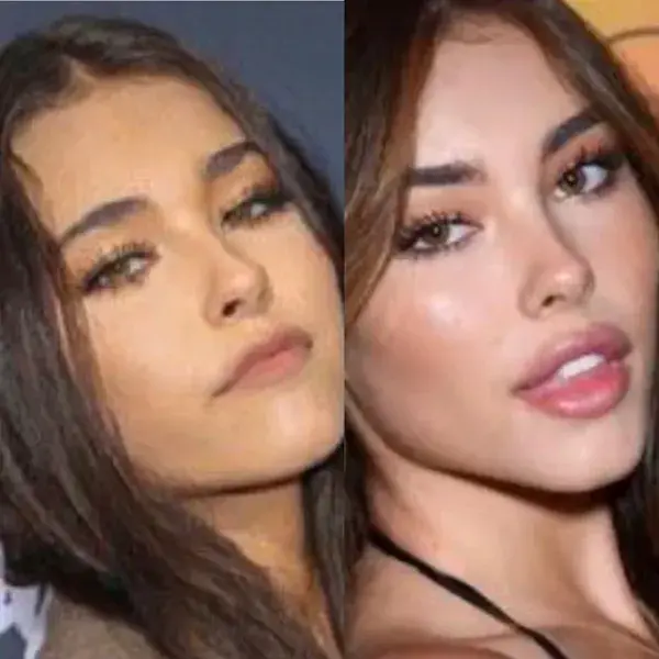 Madison Beer plastic surgery