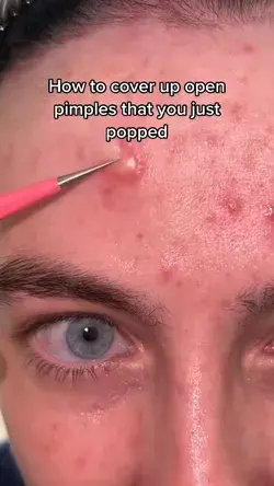 Cover up an open pimple