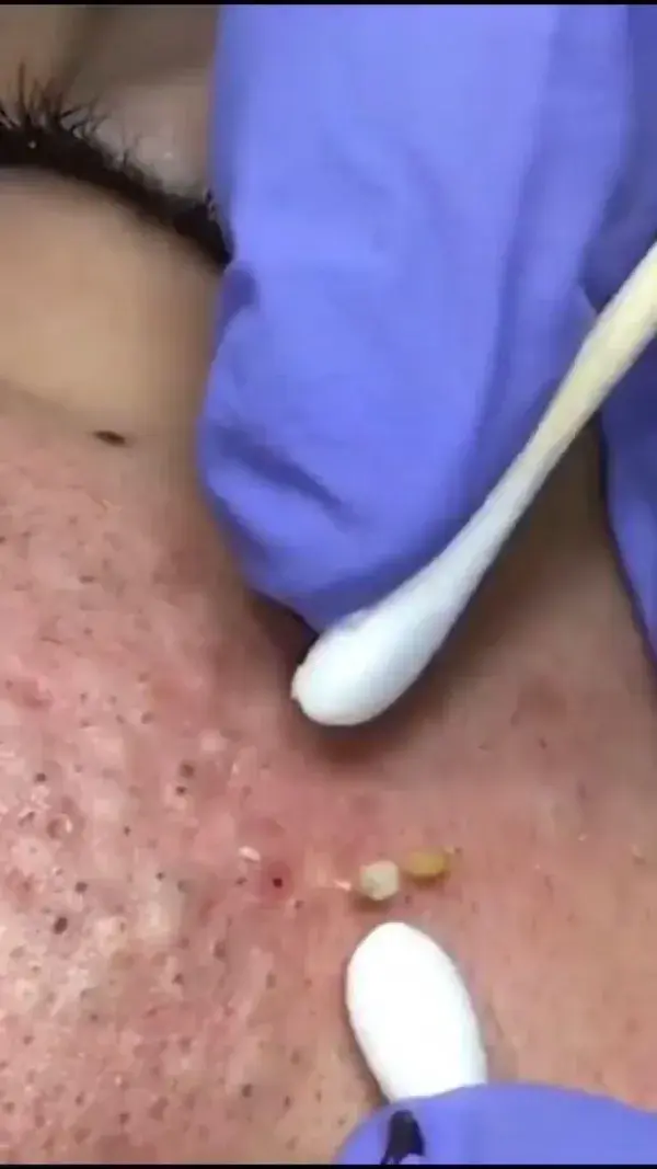 Blackheads satisfying removal