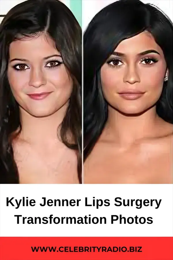 Kylie Jenner Lips Surgery Transformation Photos