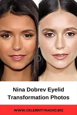 Nina Dobrev Eyelid Transformation photos