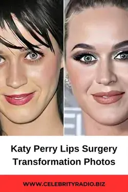 Katty Perry Lips Surgery Transformation Photos