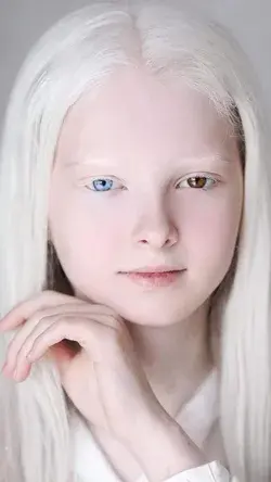 Amina Ependieva Girl with Albinism and Heterochromia, Chechnya, Russia. Credit:(@aminaarsakova)