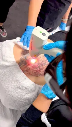 Tattoo removal ⚡️ IG: ashley.nni