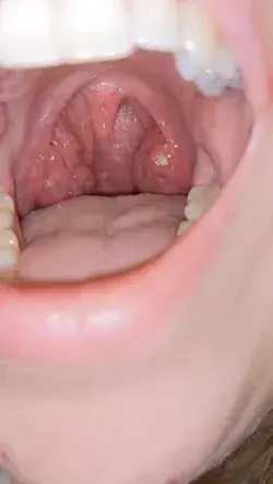 REMOVE YOUR TONSIL STONES WITH THE RIGHT TOOL