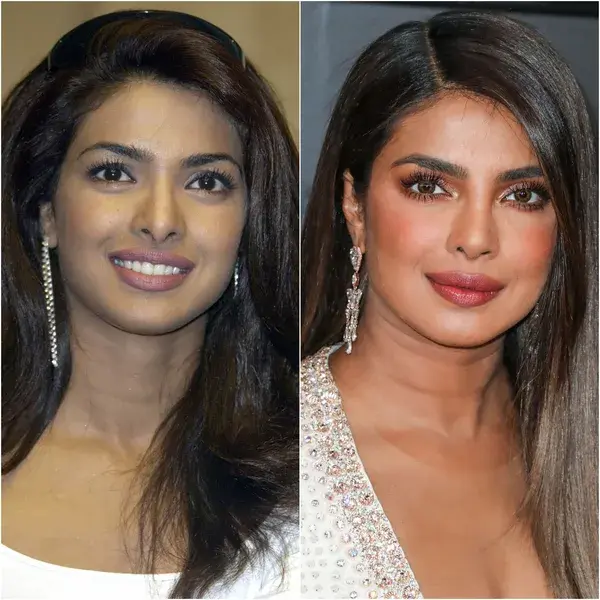 Priyanka Chopra explains in her memoir why she’s gotten multiple nose surgeries