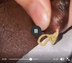 Blackheads Removal Popping