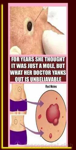 FOR YEARS SHE THOUGHT IT WAS JUST A MOLE, BUT WHAT HER DOCTOR YANKS OUT IS UNBELIAVABLE