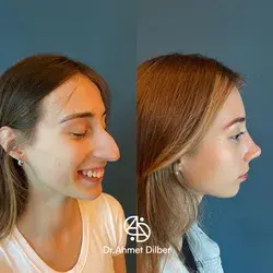 Rhinoplasty Result - Dr. Ahmet Dilber