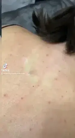 So big blackhead