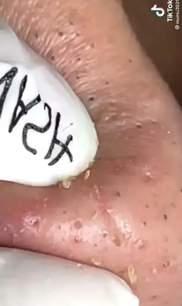 Blackheads popping removal and extraction