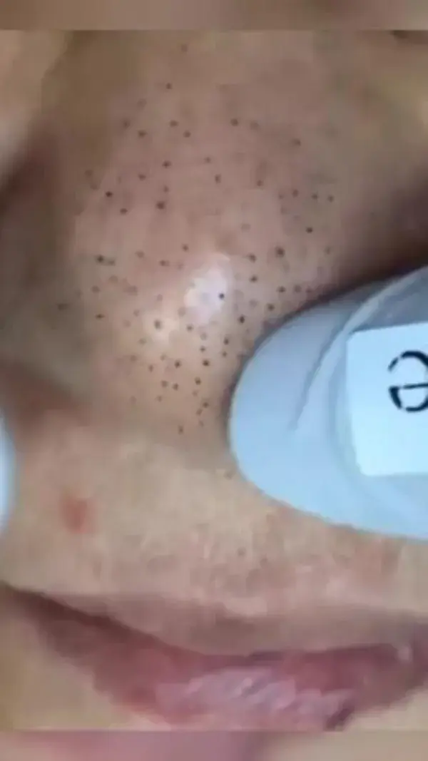 #pimple popper and #blackheads removal