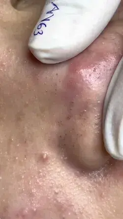 blackheads removal from the nose