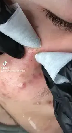 Blackheads