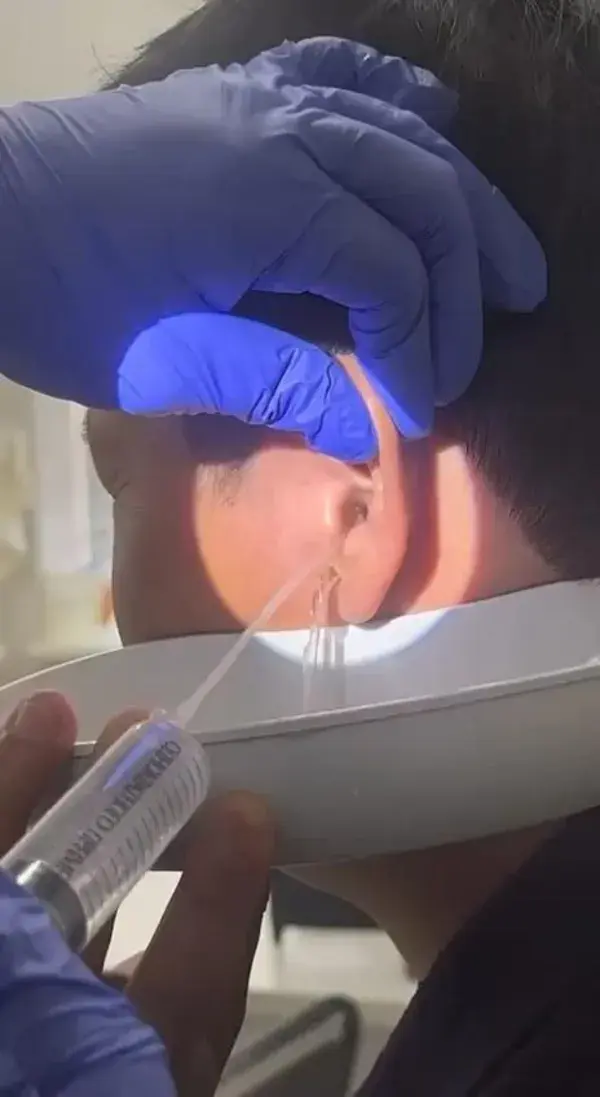 Earwax removal