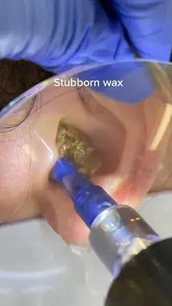 REMOVE STUBBORN EARWAX...