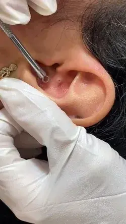 Ear Extraction. Skin Treatment, Acne, Black heads