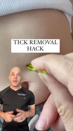 Doctor explains the perfect tick removal method!!