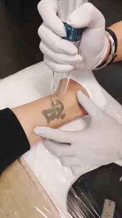 Tatto Remove