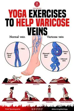 Yoga Exercises to Help Varicose Veins