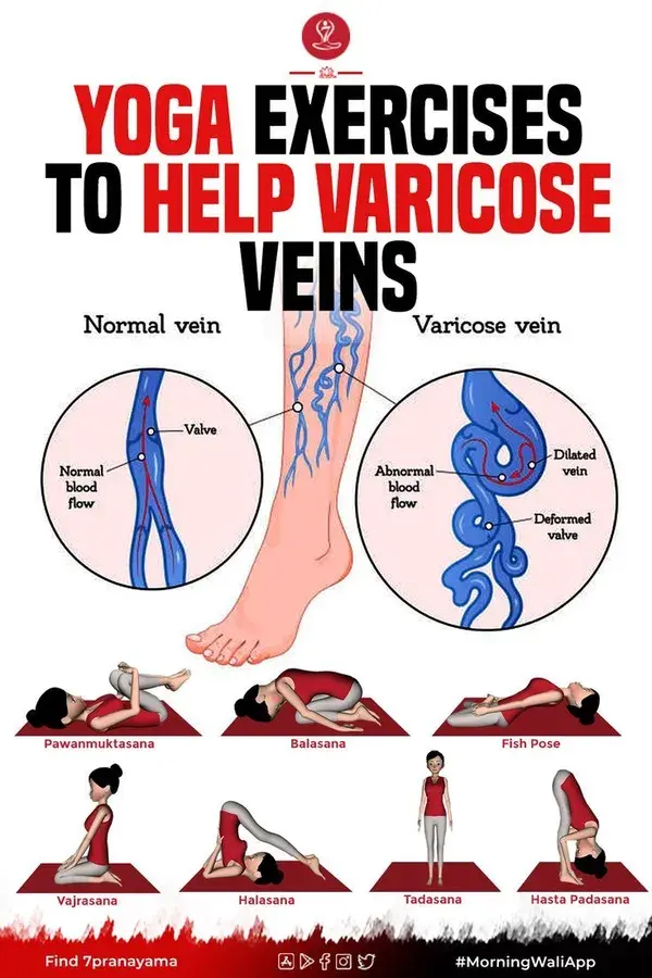 Yoga Exercises to Help Varicose Veins