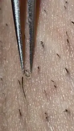 Removing ingrown hair