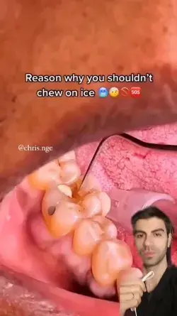 Ice broke this tooth