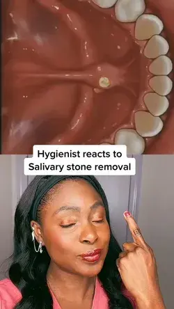 Salivary Stones