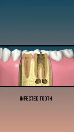 Root canal procedure🦷