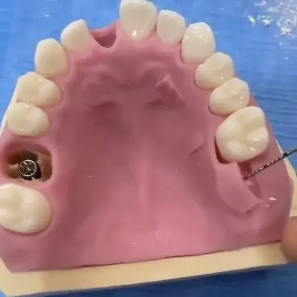 Model for Tuberosity harvesting , palate harvesting .