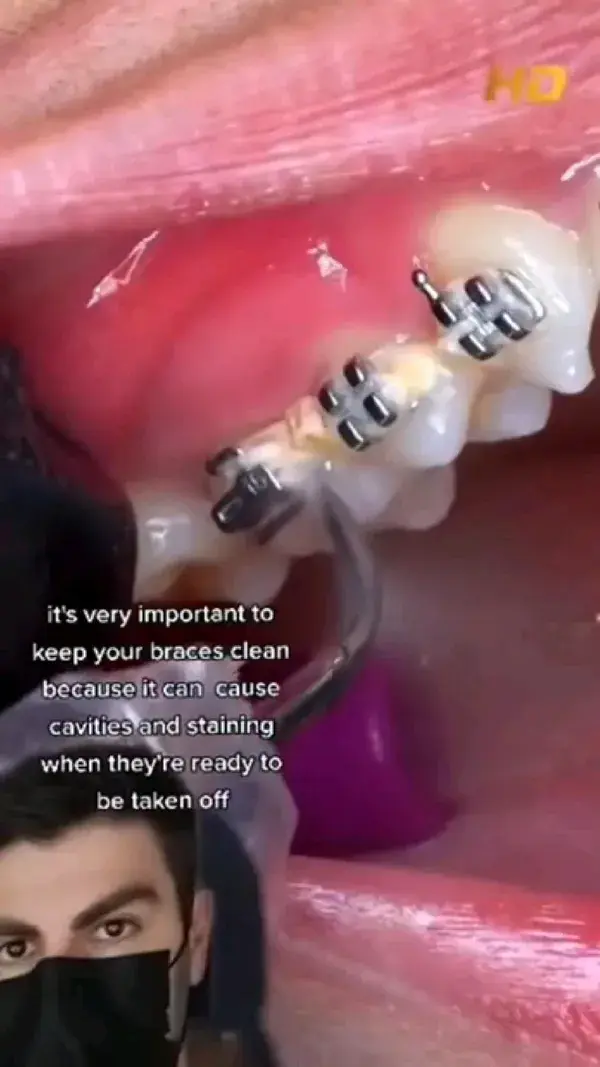 cleaning dirty braces