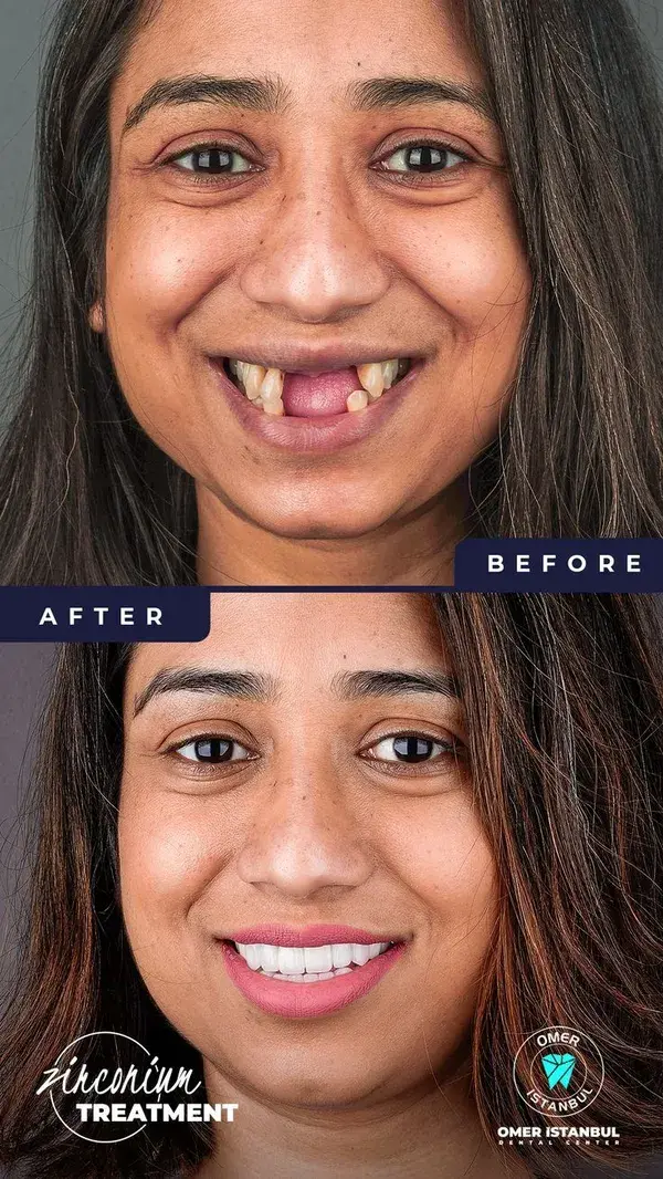 Zirconium Crown Dental Treatment - Dental Before After - Omer Istanbul Dental Center