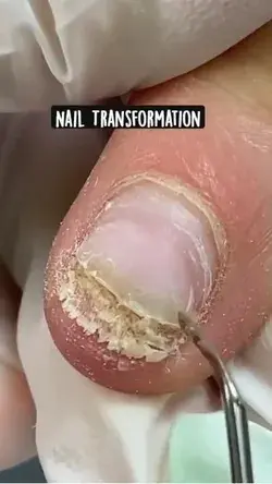 Nail Transformation