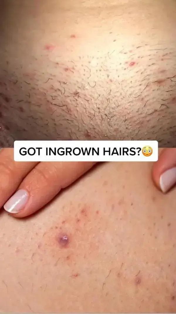 For ingrown hairs������