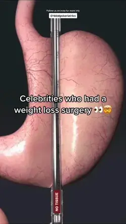 Celebrities Who had a weight loss surgery