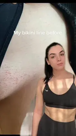 Bikini line before and after