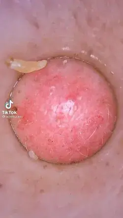 Blackheads removal