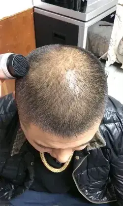 Hair Building Fiber Hides Bald Head in Seconds