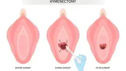 Imperforate Hymen Causes, Symptoms, and Treatment