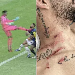 Matheus Cunha's neck after this clash with Ecuador's goalkeeper 😲