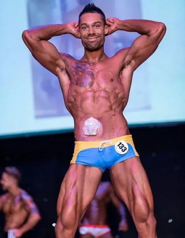 Bodybuilder Defies Doctors To Win Fitness Competition After Being Fitted With A Colostomy Bag