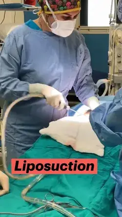 Liposuction