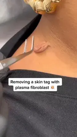 Removing A Skin Tag With Plasma Fibroblast