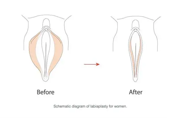 Check Out The Benefits Of Labiaplasty With Radiant!